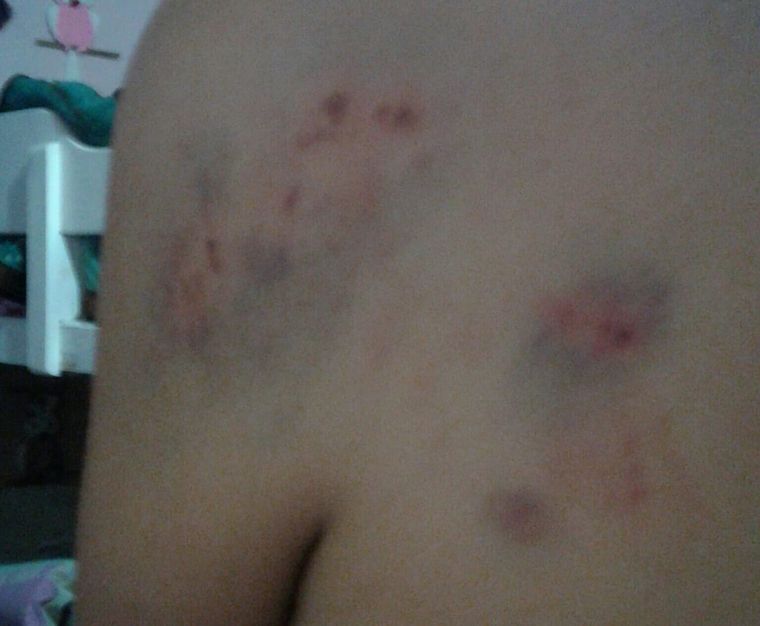 Lesiones ocasionadas por el ataque de los perros.