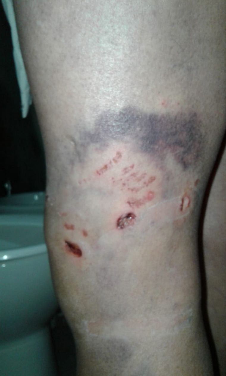 FOTO: Lesiones ocasionadas por el ataque de los perros.