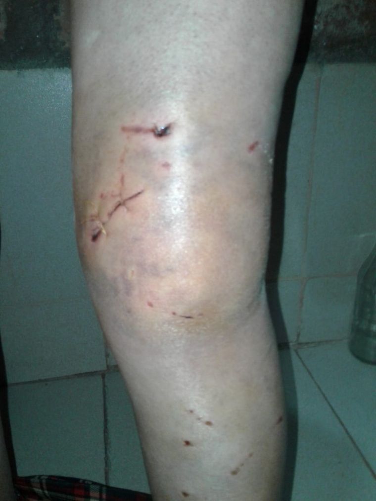 Lesiones ocasionadas por el ataque de los perros.