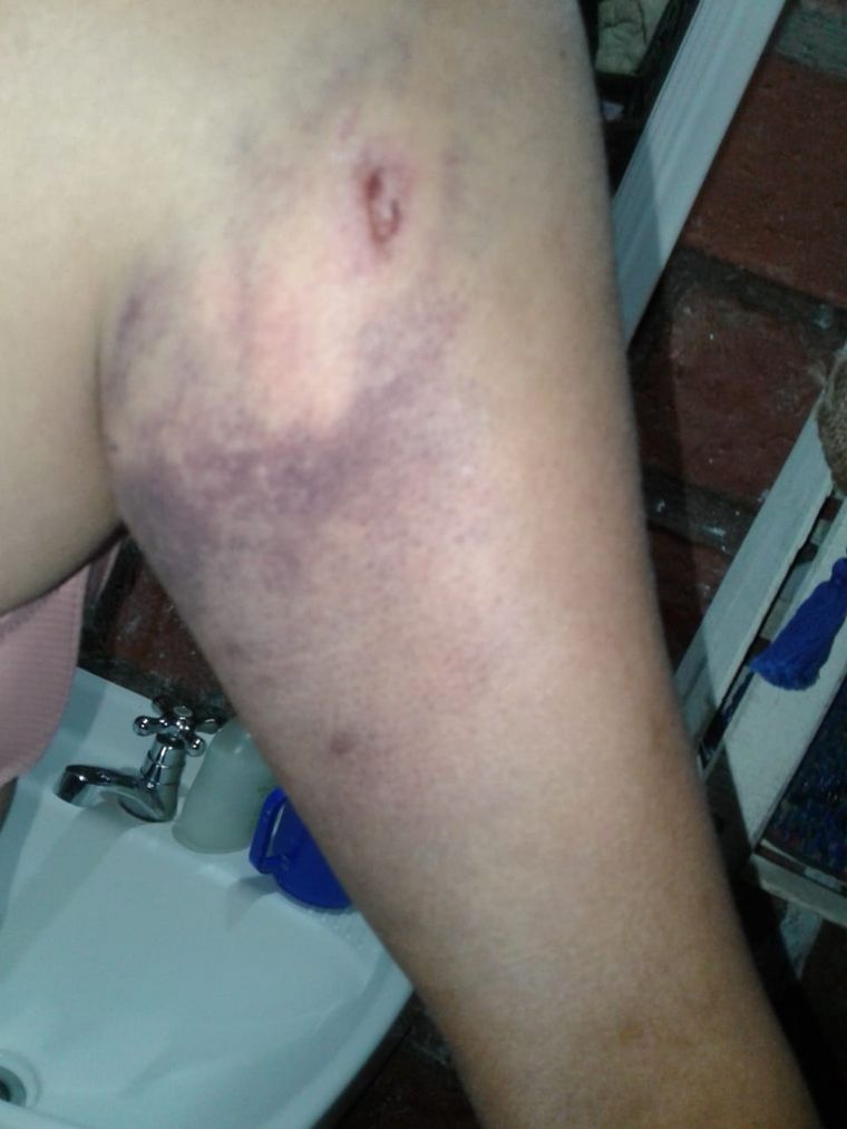 Lesiones ocasionadas por el ataque de los perros.