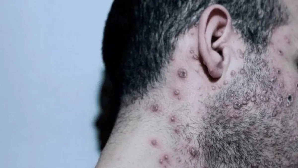 Confirmaron el primer caso de viruela del mono en Rosario.