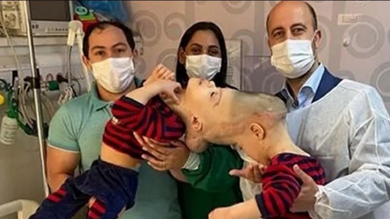 La separación de los gemelos se realizó exitosamente y duró 27 horas.