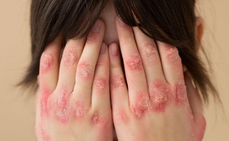 29 de octubre Día Mundial de la psoriasis