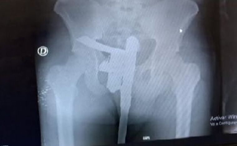 FOTO: Descubrieron a un paciente armado en Santa Fe gracias a una radiografía.