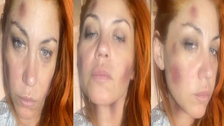 La cantante acusó a su expareja por los golpes en su rostro