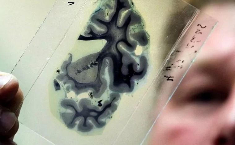 FOTO: Detectan un caso de Alzheimer en un joven de 19 años